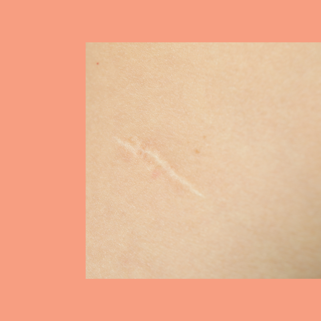 Tratamento e prevenção de cicatrizes hipertróficas e queloides