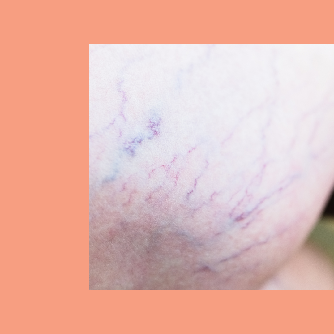 Tratamento de vasinhos do rosto e corpo