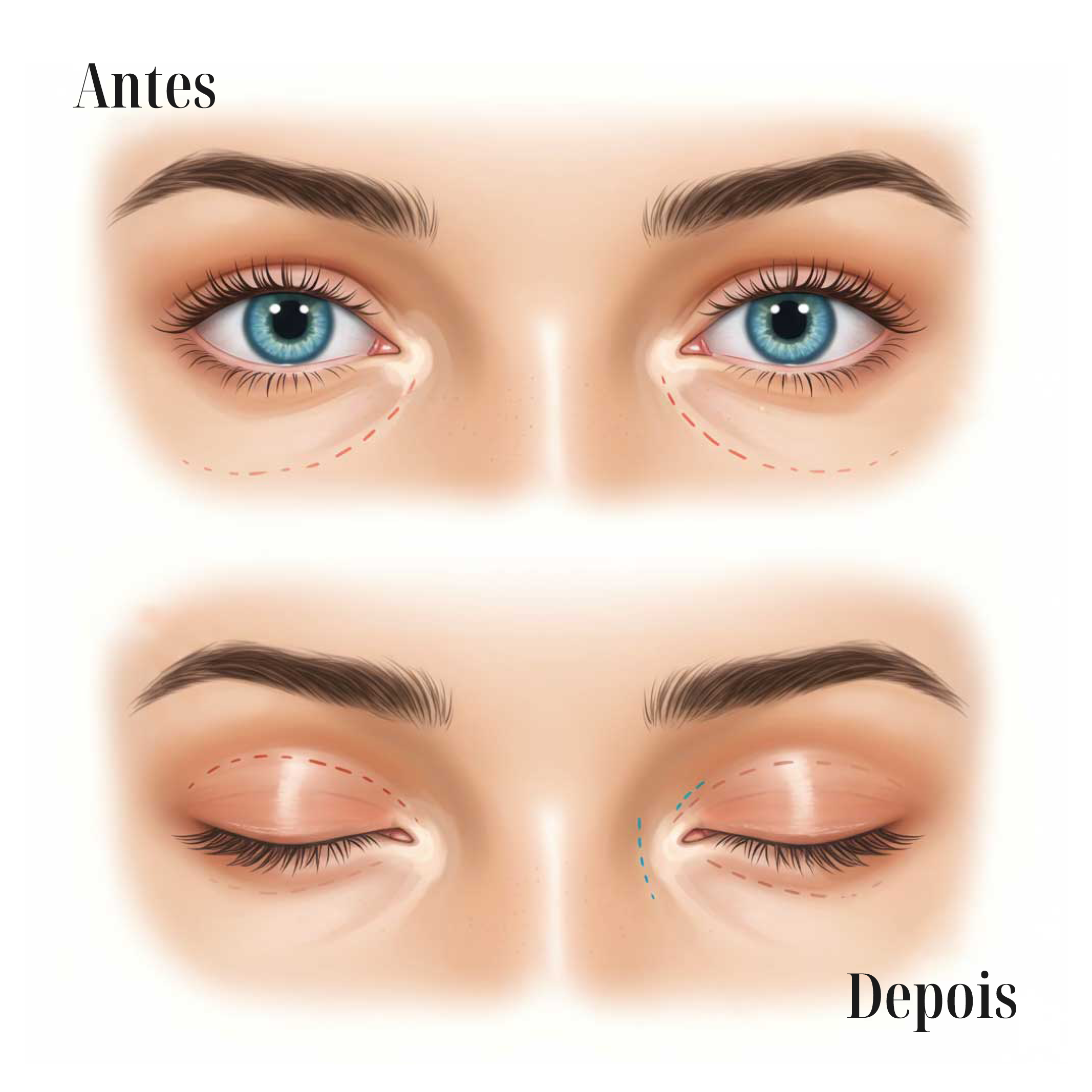 Cirurcia de Blefaroplastia