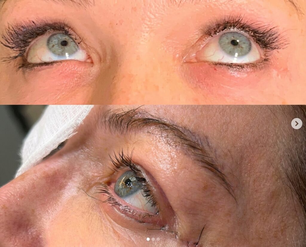 Rejuvenescimento do olhar